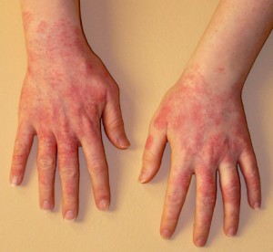Latex allergy - Mayo Clinic