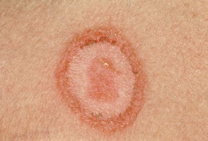 Is ringworm contagious?